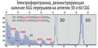 электрофореграмма при AGG перерывах на аллелях 30 и 60 CGG