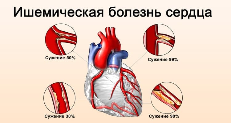 ишемическая болезнь сердца