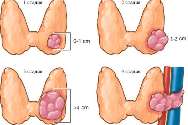 стадии рака щитовидной железы