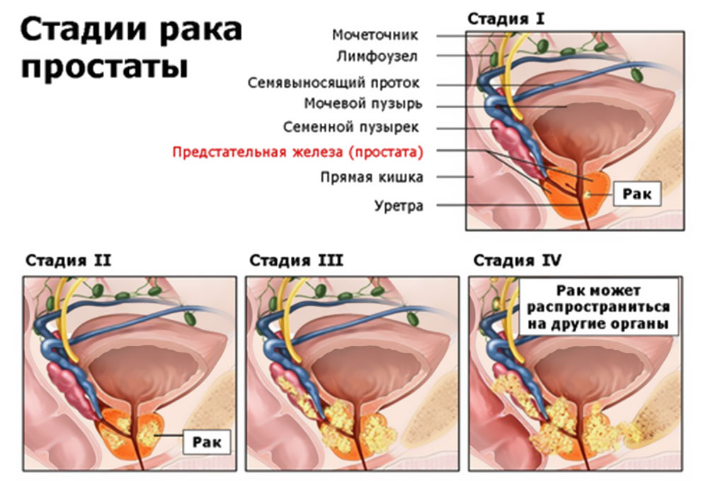 стадии рака предстательной железы