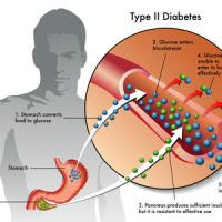 Сахарный диабет: причины, симптомы и лечение